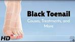 شاهد فيديو يشرح أسباب وحلول أظافر القدم السوداء على يوتيوب