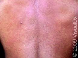 Image result for skin rash acute hiv infection