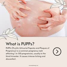 Image result for pruritic urticarial papules and plaques of pregnancy