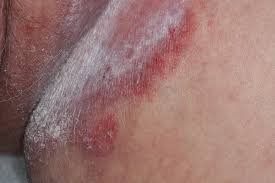 Image result for sore skin in the groin area