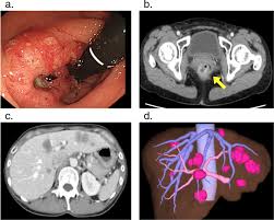 This is called a biopsy. Complete Remission Of Multiple Liver Metastases With Only Partial Response Of The Primary Rectal Cancer After Neoadjuvant Chemotherapy Surgical Case Reports Full Text
