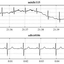 Wandering baseline means some electrical recording problem and does not relate to the patient's heart. Pdf Detection And Classification Of Baseline Wander Noise In Ecg Signals Using Discrete Wavelet Transform And Decision Tree Classifier