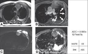 It is caused by inhaling asbestos fibers. Year Old Man With Sarcomatoid Malignant Pleural Mesothelioma A Download Scientific Diagram