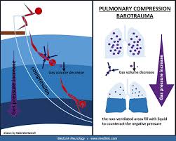 Image result for Decompression Sickness Management