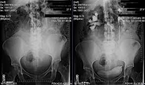 100 Blockage Of Right Ureter Think Kidney Stone I Ve Never Been In So Much Pain Before Hadtohurt