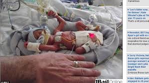 22 semanas equivalem a aproximadamente 5,1 meses. Bebe Nasce Prematuro Com 450 Gramas E Sobrevive Saude E Ciencia Extra Online