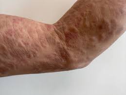 成人 t 細胞 白血病 リンパ腫 ブログ