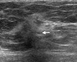 Because ibc grows quickly, it is usually found at a locally advanced stage, meaning that cancer cells have spread into nearby breast tissue or lymph nodes. What Radiologists Need To Know About Diagnosis And Treatment Of Inflammatory Breast Cancer A Multidisciplinary Approach Radiographics