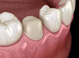 Signs you need a root canal. Do You Always Need A Crown After A Root Canal Family Choice Dental Albuquerque New Mexico
