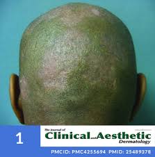The inflammation could be triggered by an infection or exposure to certain substances in your environment. Rare Scalp Conditions That Can Cause Permanent Hair Loss