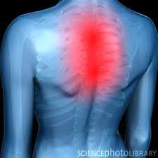 Pin On Upper Back Pain