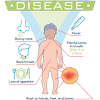 The chance of surviving bowel cancer for at least five years, is 70%. 1