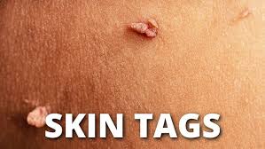 Image result for Skin Tag