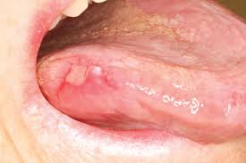 Mouth cancer, also known as oral cancer, can develop on the surface of the tongue, the inside of the cheeks, the roof of the mouth and the lips or gums.like all cancers, there's currently no. Early Detection Of Mouth Cancer Improving Success Dentistry Co Uk