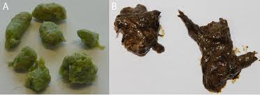 Image result for acholic stools human