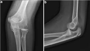 It is still controversial whether fresh avulsion fractures of the medial or lateral epicondyle of the humerus in adults should be treated conservatively or surgically. The Ap A And Lateral View B Of The Elbow Showing The Avulsion Download Scientific Diagram