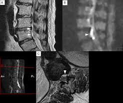 Image result for Spinal Epidural Abscess