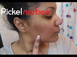 Maybe you would like to learn more about one of these? Akne Und Pickelnarben Dunkle Flecken Im Gesicht Das Konnte Dir Helfen Request Youtube