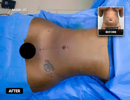 Often, patients are surprised to learn that they tend to weigh more immediately following surgery, which is due to excess fluid buildup that occurs as a result of the procedure and subsides within days. Liposuction Miami Life Plastic Surgery