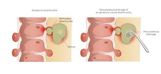 Image result for Diverticulitis