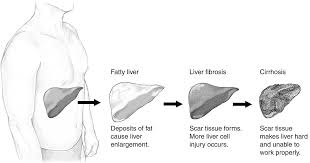 Non Alcoholic Fatty Liver Disease Wikipedia
