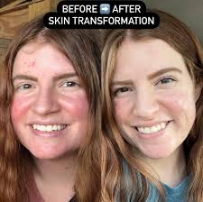 🌟Introducing: Skincare By Kylie Gospodarek Hello, Bellevue! I am Kylie  Gospodarek and as of April 1st, I am offering my Skincare services at  YOUnique Wellness Center. I specialize in acne skin but