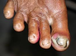 Image result for Paronychia feet