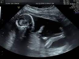 20 Week Ultrasound Its A Boy Youtube Ultrasound Pictures Boy Ultrasound Boy Ultrasound Pictures