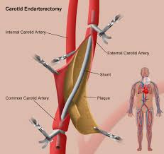 Image result for carotid artery