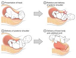 Image result for Shoulder Presentation