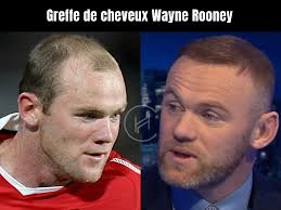Wayne Rooney : greffe de cheveux