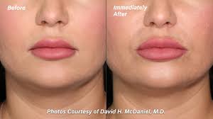 The quality of the lip filler you choose will have an impact on how long your treatments last. Restylane Kysse David H Mcdaniel Md Laser Center And Medical Spadavid H Mcdaniel Md Laser Center And Medical Spa