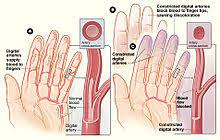 Raynaud Syndrome Wikipedia