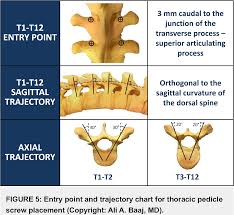 Figure 5 From Freehand Thoracic Pedicle Screw Placement