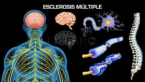 Hablemos sobre qué es lo que provoca esta obstrucción en la trasmisión de las señales. Dudas En Neurologia 16 Sintomas Tempranos De La Esclerosis Multiple