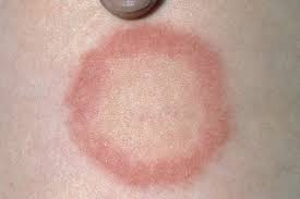 Find out how to treat ringworm today with these easy and effective treatments. Ringworm Nhs