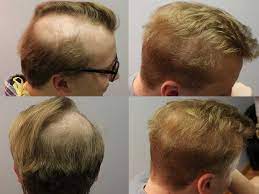 These symptoms can also include hot flashes, night sweats, mood swings, insomnia, and vaginal dryness. Hair Loss After Surgery How To Grow Your Hair Back Lewigs
