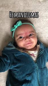 Hemangioma Babies Dla