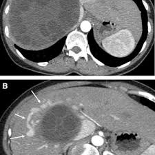 Diagnosis Of Budd Chiari Syndrome Request Pdf