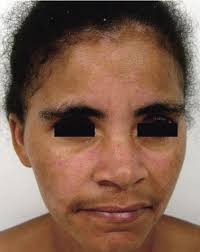 Cutaneous manifestations associated with HTLV‐1 infection