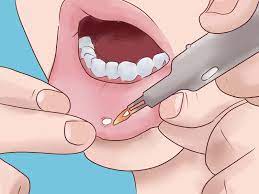 How To Remove A Mouth Ulcer Canker Sore Mouth Ulcer Treatment Tongue Ulcer Remedies
