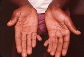 Check spelling or type a new query. Polydactyly Symptoms Causes And Treatments