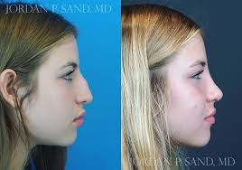 This beautiful young patient did not like her nose. It was large, crooked  and bothered her immensely. She wanted to have a smaller, cuter nose.