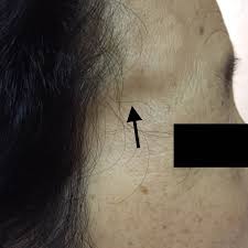 Image result for Jaw Claudication