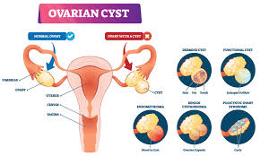 My ovaries since the surgery it the same pain that i had before for years only thing it had got worse since this year before the surgery and after it. Complications Of Ovarian Cystectomy Health Plus