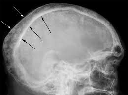 Image result for Skull XRay