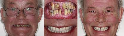 Full Mouth Treatment Kaizen Dental Implants