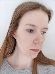 Hair loss in these cases is typically not permanent. My Experience With Acne On The Contraceptive Pill Both The Mini And Combined Pills Annie S Noms