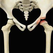 A better outcome is defined as a round femoral. Perthes Disease Salt Lake City Ut Osteotomy Provo Ut