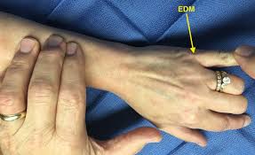 Image result for Elson Extensor Tendon Test